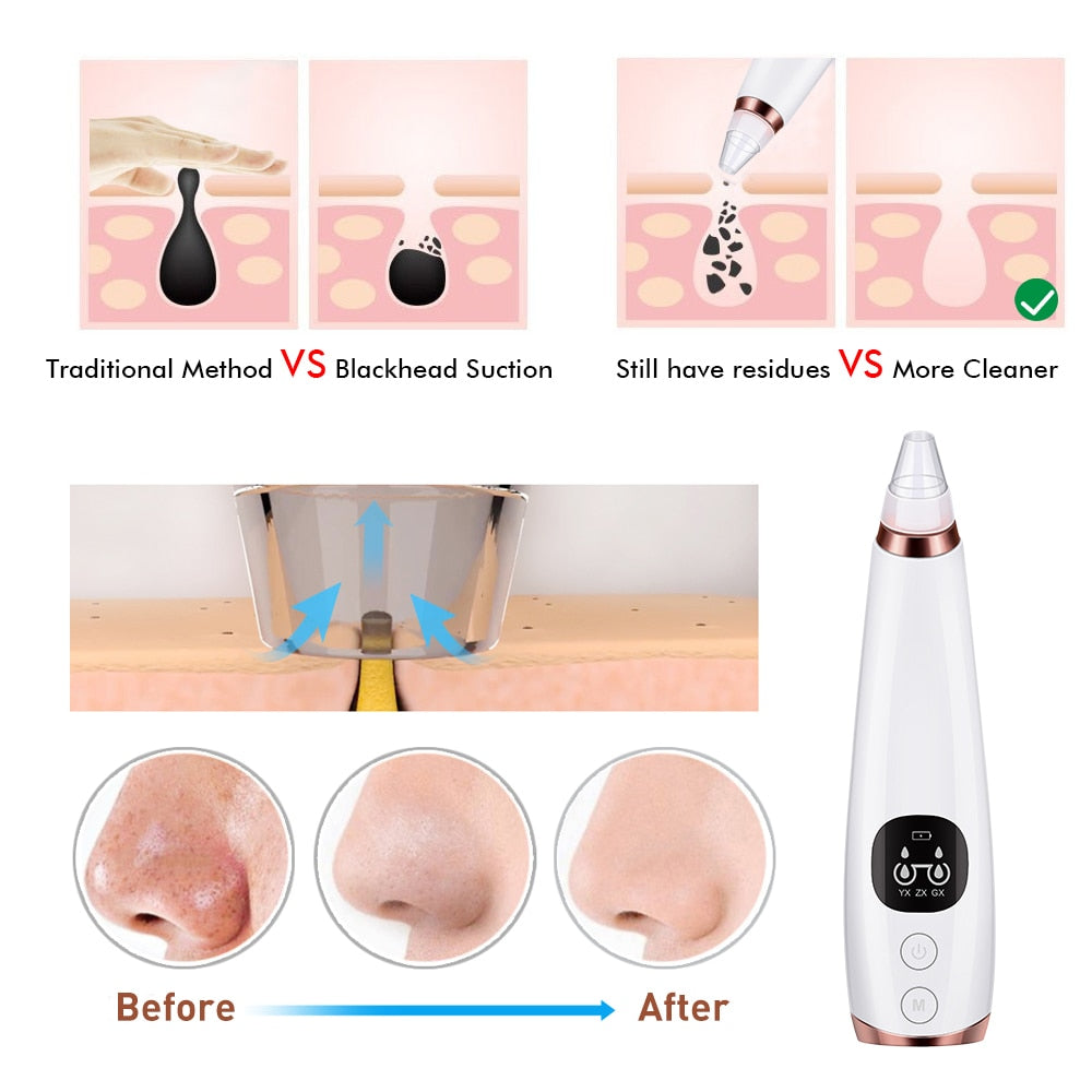 BELLA BODZ® Electronic Blackhead Vacuum Pore Cleaner