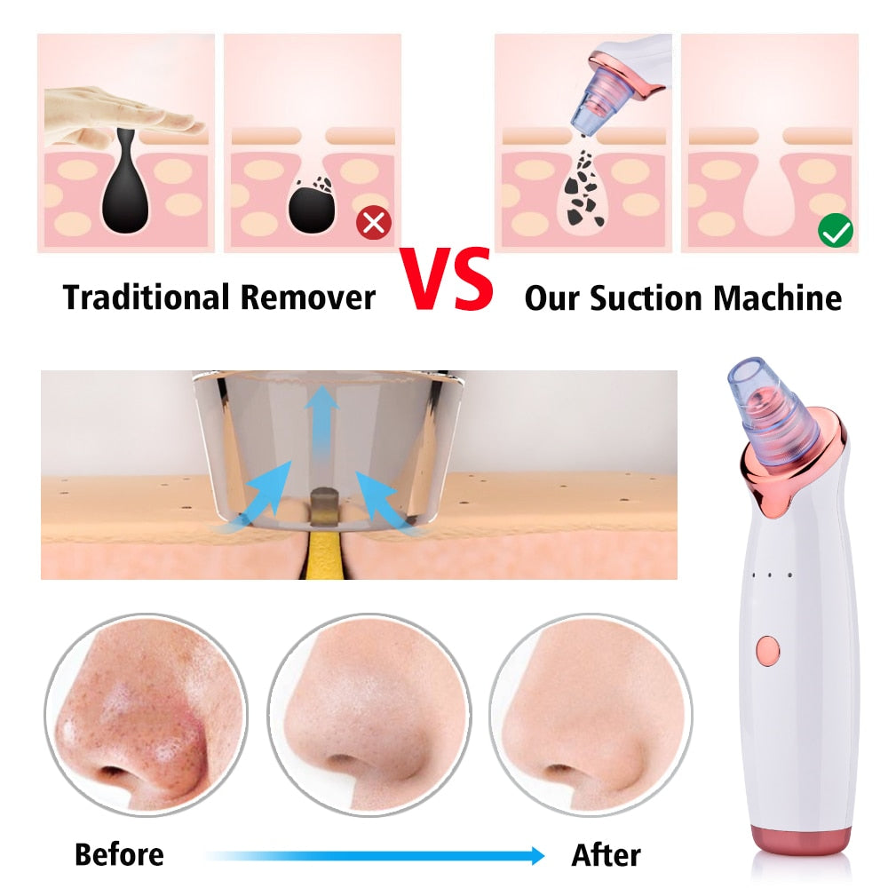 BELLA BODZ® Electronic Blackhead Vacuum Pore Cleaner