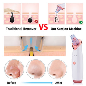 BELLA BODZ® Electronic Blackhead Vacuum Pore Cleaner